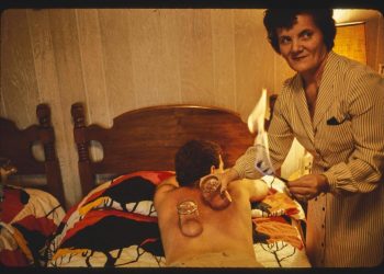 Βεντούζες: Όλα για το γιατροσόφι που κάποιοι ορκίζονται σε αυτό