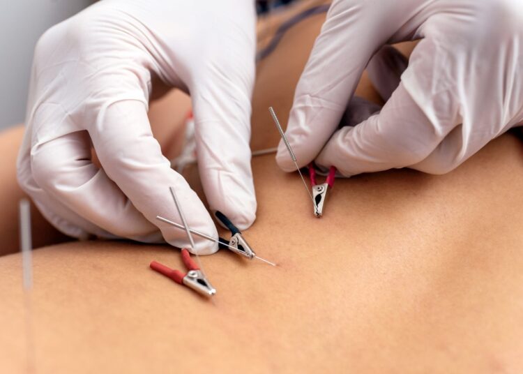 Γνωρίστε τον Ηλεκτροβελονισμό